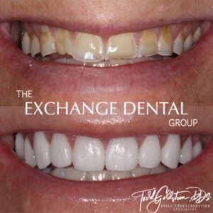 Transformation Four | The Exchange Dental Group