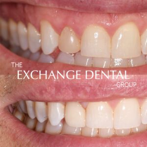 Transformation One | The Exchange Dental Group